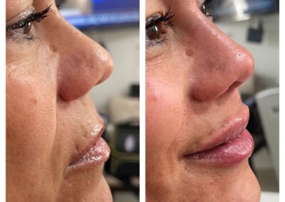 Rinomodelación: Obtén una nariz equilibrada y estética de manera rápida, segura y con resultados naturales. Transformación sin cirugia.